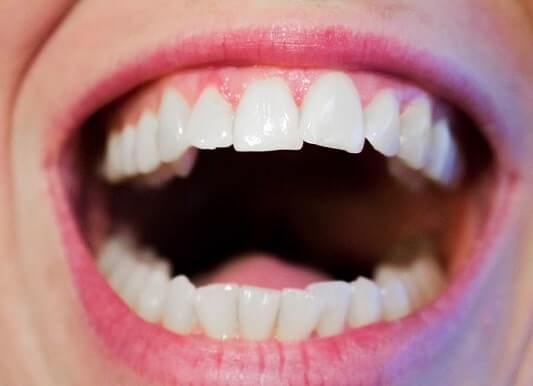 brackets transparentes